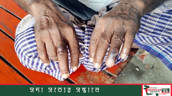 Anthrax-Infected-Patients-Upazila-Health-Complex